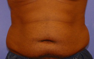 belly buldge and fat removal with coolsculpting