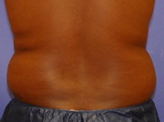 mens back fat removal with coolsculpting