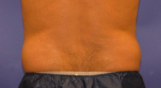 photo of coolsculpting patient