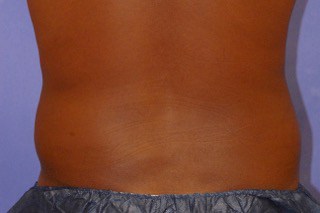back fat removal with coolsculpting