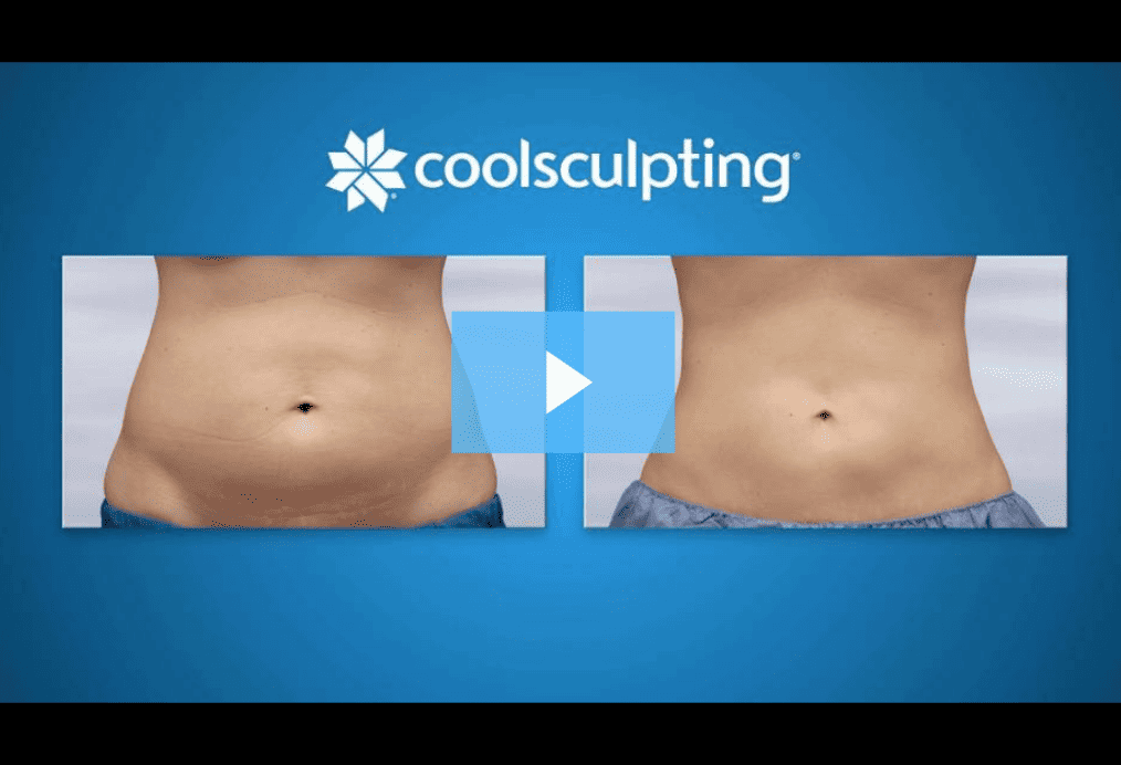coolsculpting before and after picture