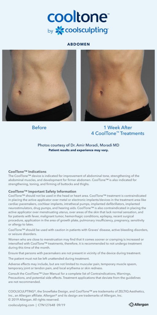 noninvasive abdomen fat removal information sheet