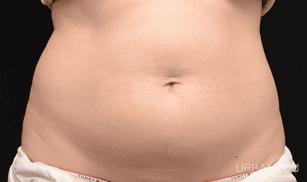 before photo of stomach body sculpting