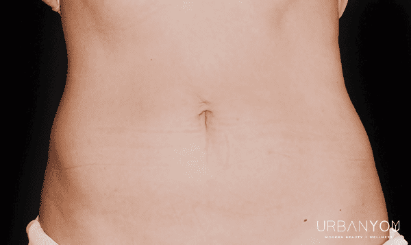 after photo of stomach coolsculpting at urban you med spa