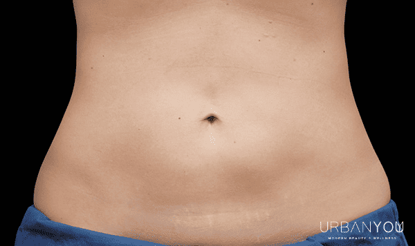 after photo of stomach body sculpting at urban you