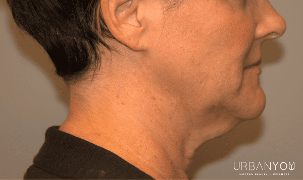 before photo of neck and chin coolsculpting at urban you