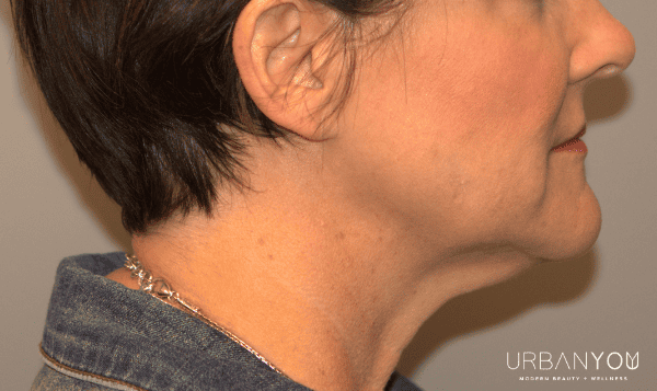 after photo of neck and chin after coolsculpting at urban you