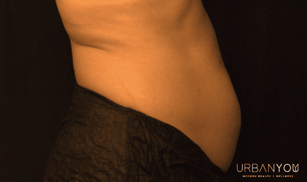 photo of stomach from urban you coolsculpting