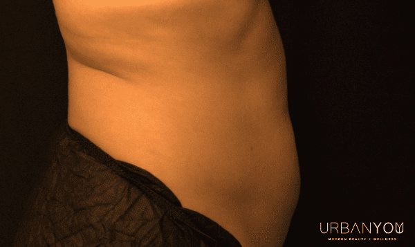 urban you coolsculpting before and after