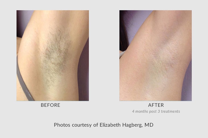 Laser Hair Removal before & after photos at Urban You medical spa in Grand Rapids and Norhville, Michigan